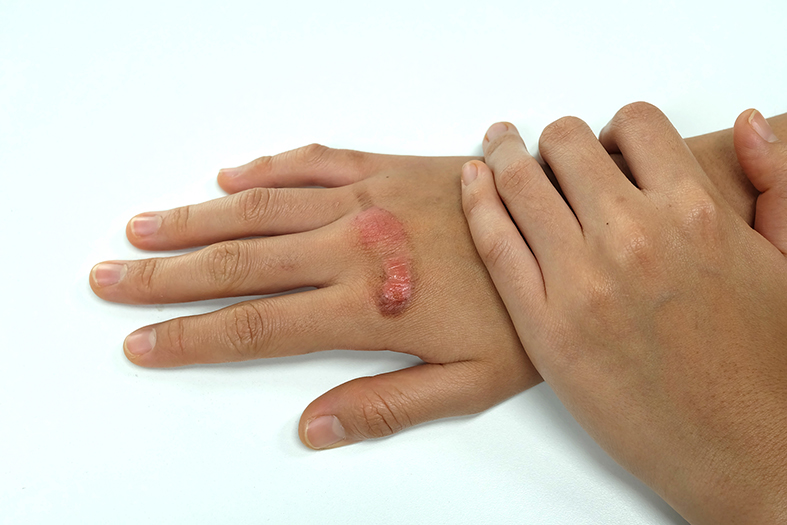 نحوه استفاده از پماد آبیلار