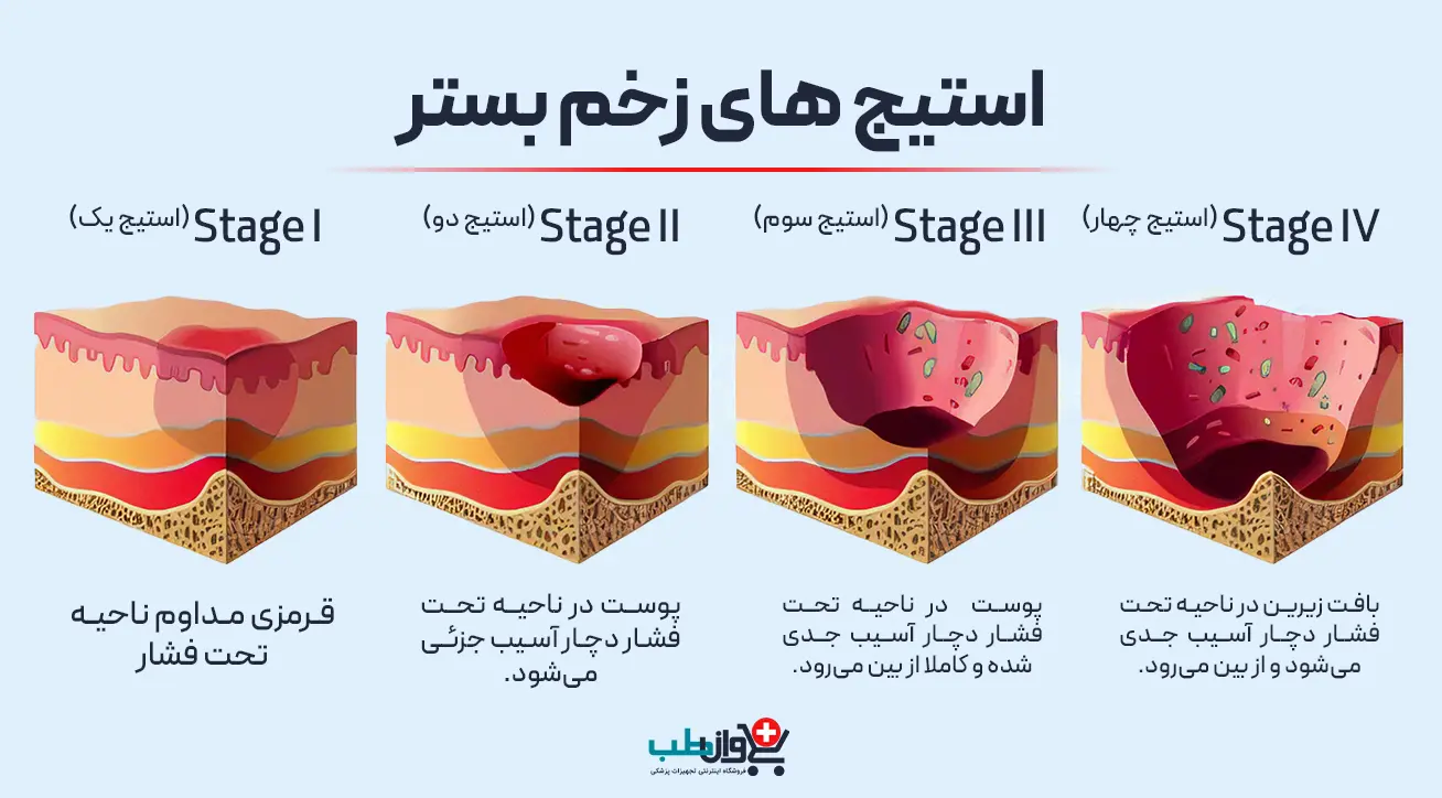 مراحل یا استیج های زخم بستر
