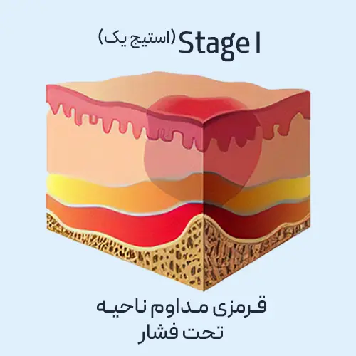 زخم بستر - مرحله یک
