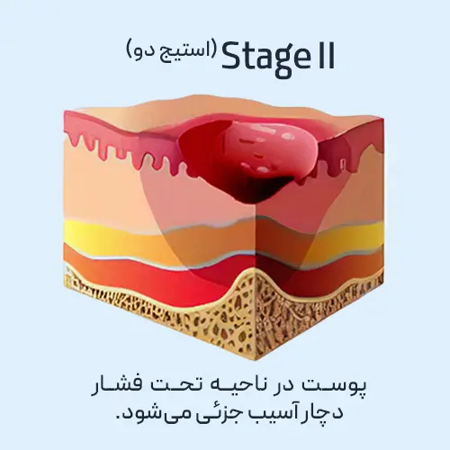 زخم بستر - مرحله دو