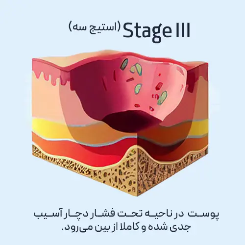 زخم بستر - مرحله سه