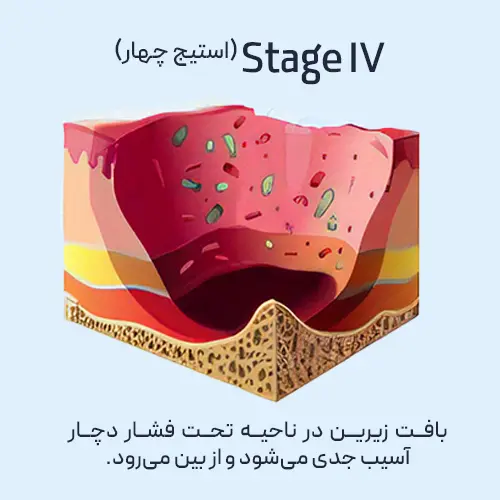زخم بستر - مرحله چهار